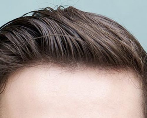 What to do after a hair transplant?