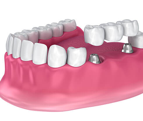 Dental bridge Turkey