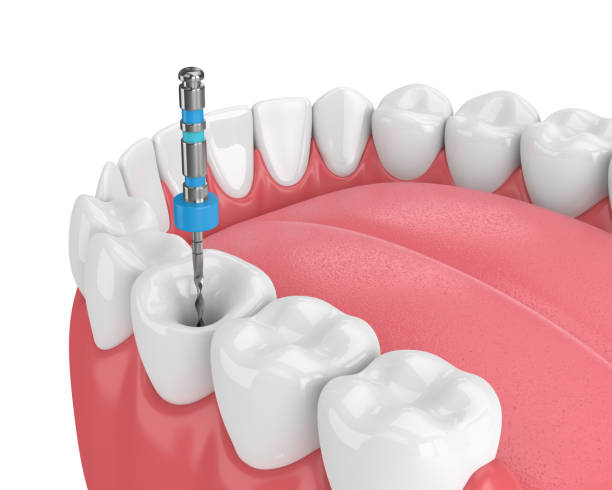 Endodontics Turkey