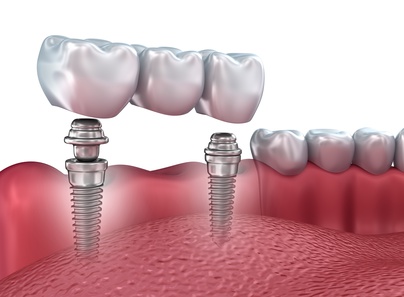 Dental implants’ placement : how to manage the postoperative period ?