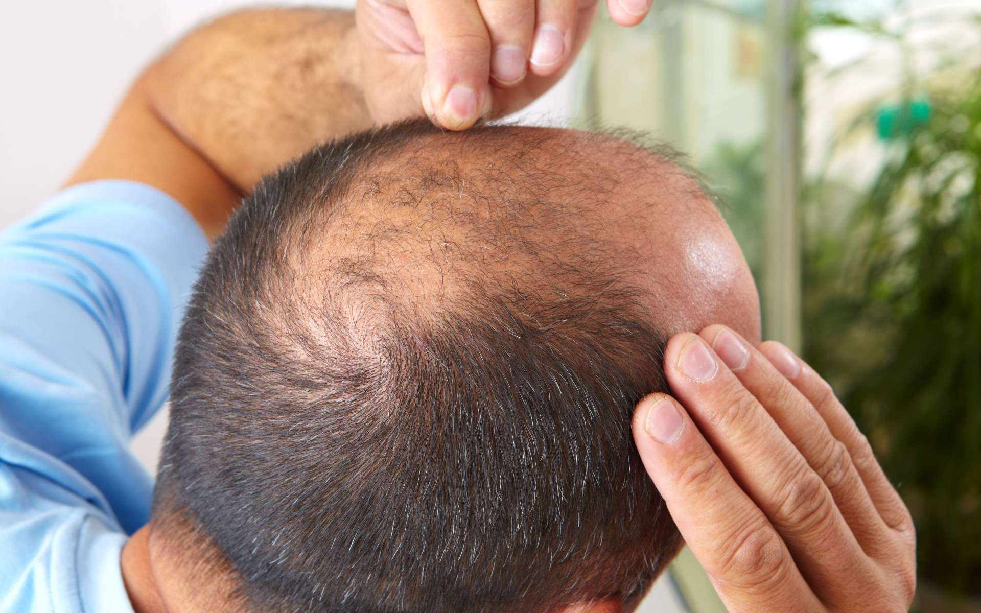 Which is the best moment for a hair transplant ?
