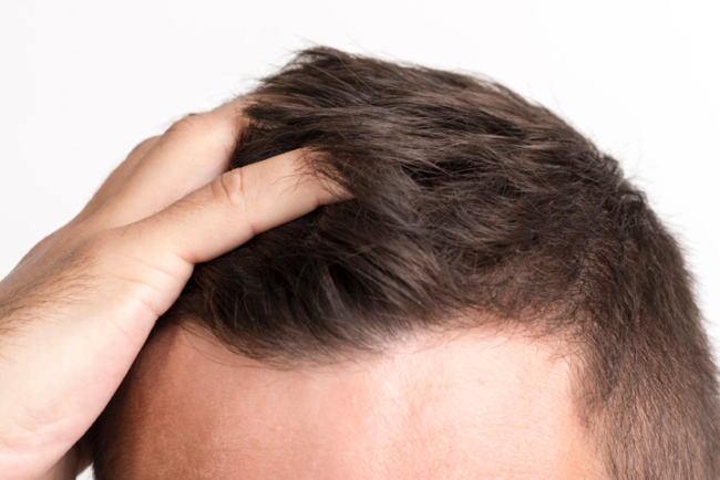 How to prepare for a hair transplant ?