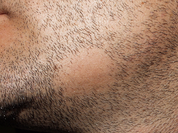 Beard hair loss : causes and treatments