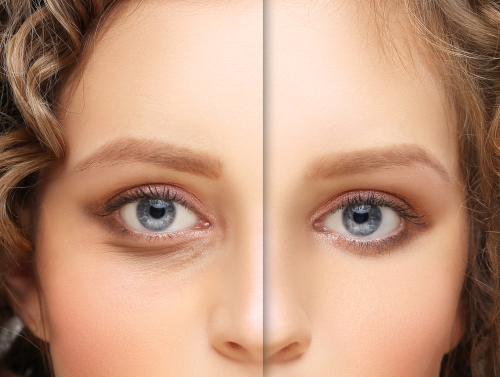 Blepharoplasty Dubai