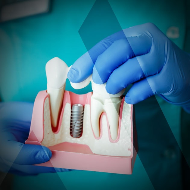 dental-implants-Turkey